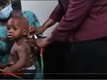 MUAC measurement as an indicator of nutritional status (videos) MUAC measurement as an indicator of nutritional status (videos)